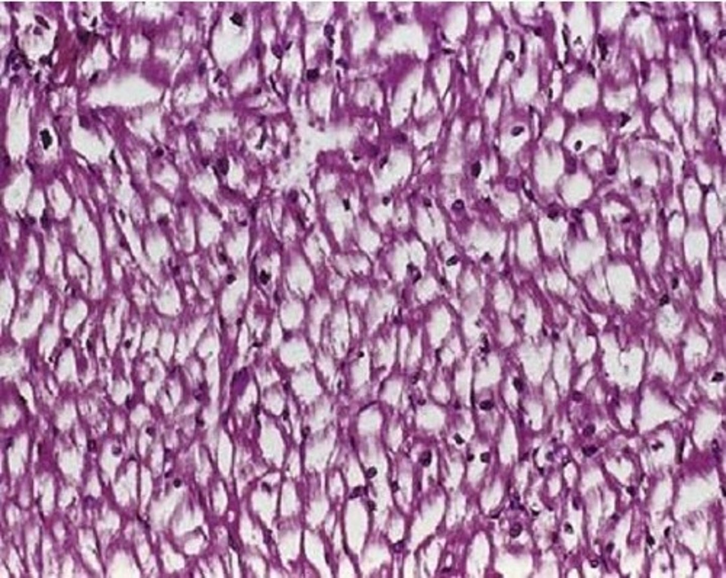 <p>Cori disease III (debranching enzyme deficiency)</p><p>Von Gierke disease IV (glucose-6-phosphate deficiency in ER, more severe with increased blood lactate)</p>
