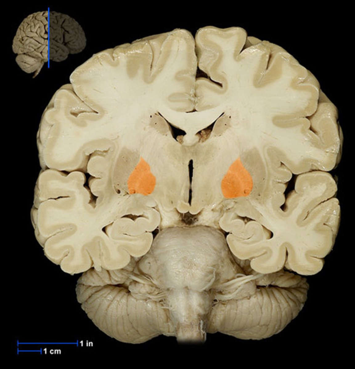 <p>more medial than putamen, appears with the third ventricle.</p>