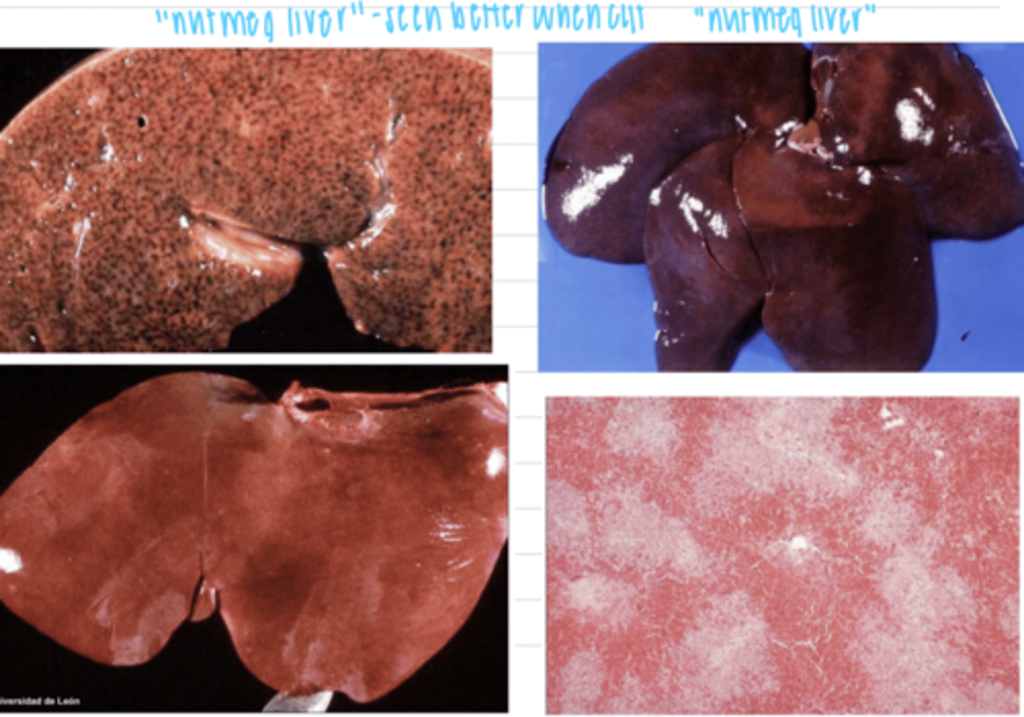 <p>chronic passive generalized congestion, caused by a right heart failure</p>