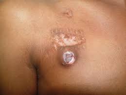 <p><span>A focal loss of the top surface of skin. Since it is superficial, the skin heals without scarring.</span></p>
