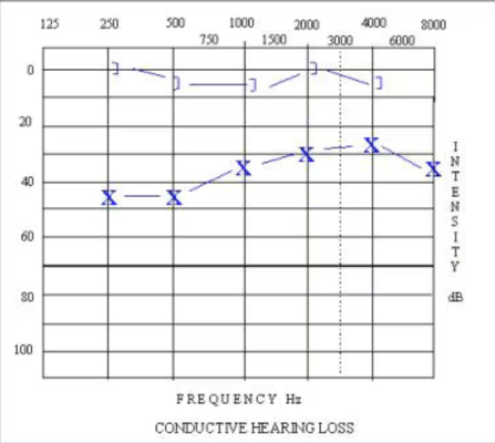 <p>dB level at 500 Hz + dB level at 1000 Hz + dB level at 2000 Hz = X/3 = PTA</p><p></p><p>Example: 45 + 35 + 30 = 36</p>