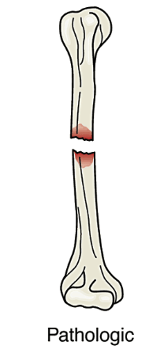 <p>Caused when bone is weakened either by pressure from a tumor or an actual tumor within the bone</p>