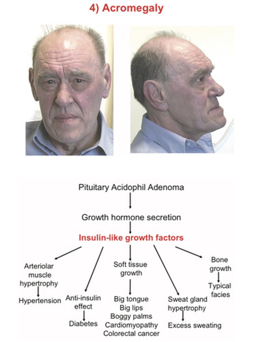 <p>enlargement of the extremities</p>