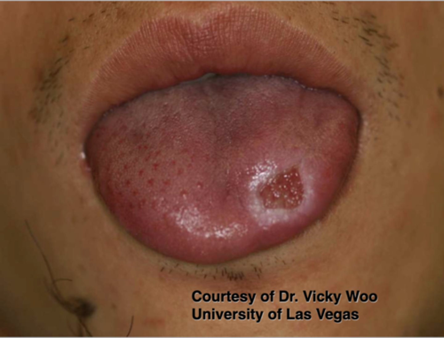 <p>Patient reported that they accidentally burned their tongue on a cigarette and have since been repeatedly accidentally biting on the lesion. What do you suspect?</p>