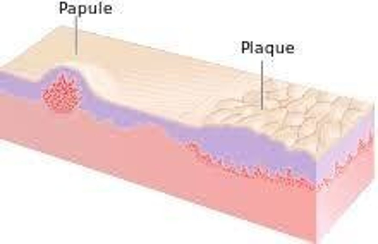 <p>Elevated small bump usually less than 1cm</p>