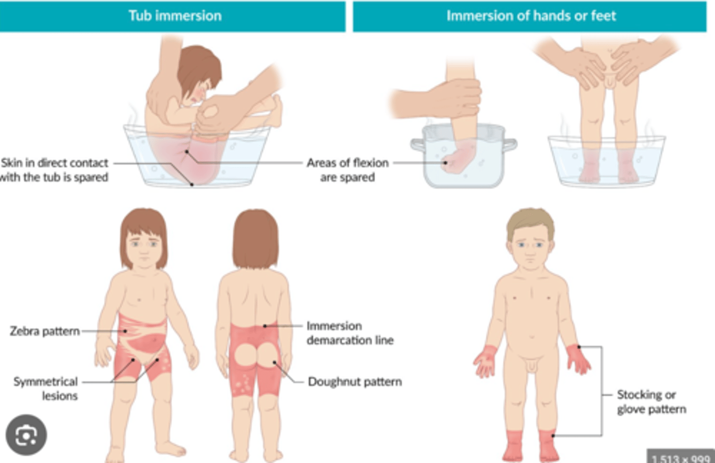<p>- Symmetrical burns of uniform depth</p><p>- restraint injuries on upper limbs</p><p>- obvious pattern from cigarettes etc</p><p>- no splash marks in a scald injury</p><p>- doughnut sign (spared skin surrounded by scald)</p>