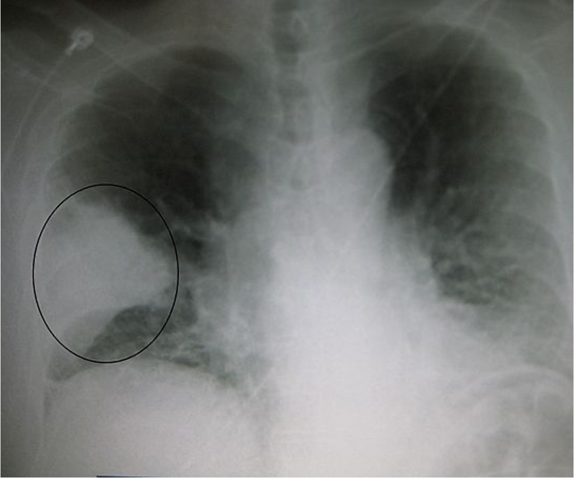 <p>what is seen on this xray?</p>