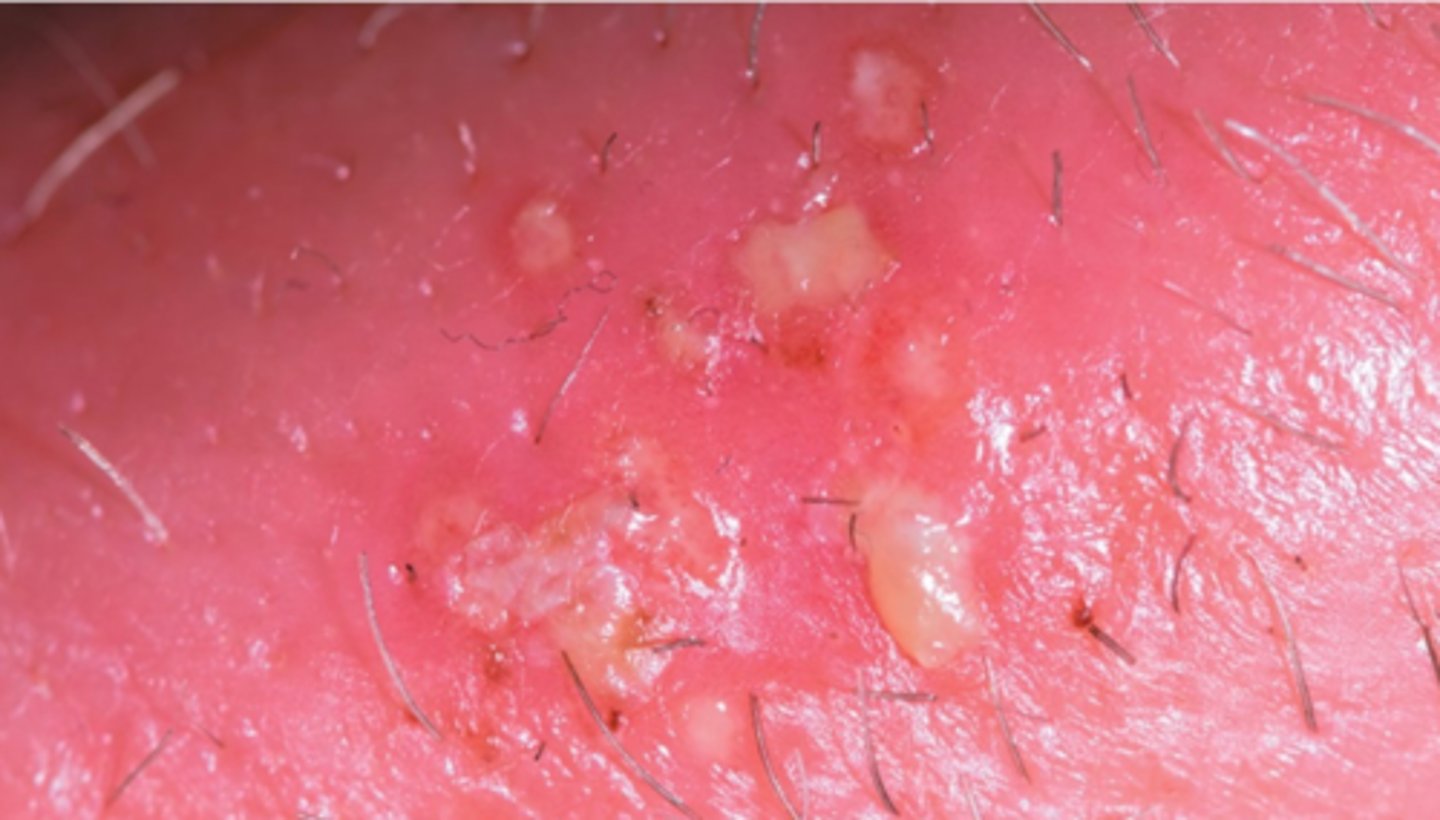 <p>genital herpes</p>