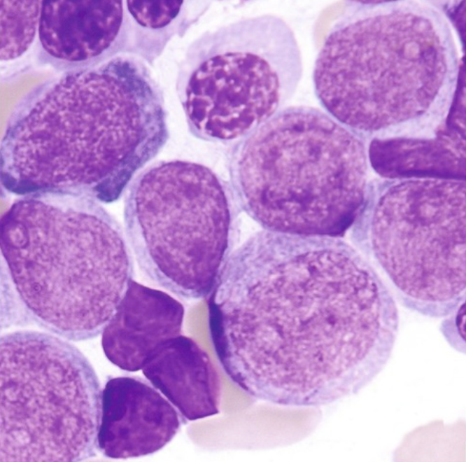 <ul><li><p>Myeloblasts are large with scant amount of gray blue cytoplasm</p></li><li><p> Nucleus can be round to oval with fine chromatin</p></li><li><p> Usually very distinct nucleoli</p></li><li><p> Auer rods present in about 50% of cases</p></li></ul><p></p>