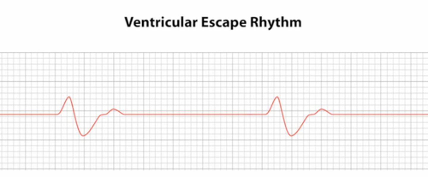<p>SA and AV node fail, so the ventricles produce an impulse to protect from asystole</p><p>RATE = 20-40 bpm</p><p>no P waves</p><p>QRS &gt; 0.12 seconds (VERY wide)</p><p>NOT IN CLINICALLY NORMAL HEARTS</p>