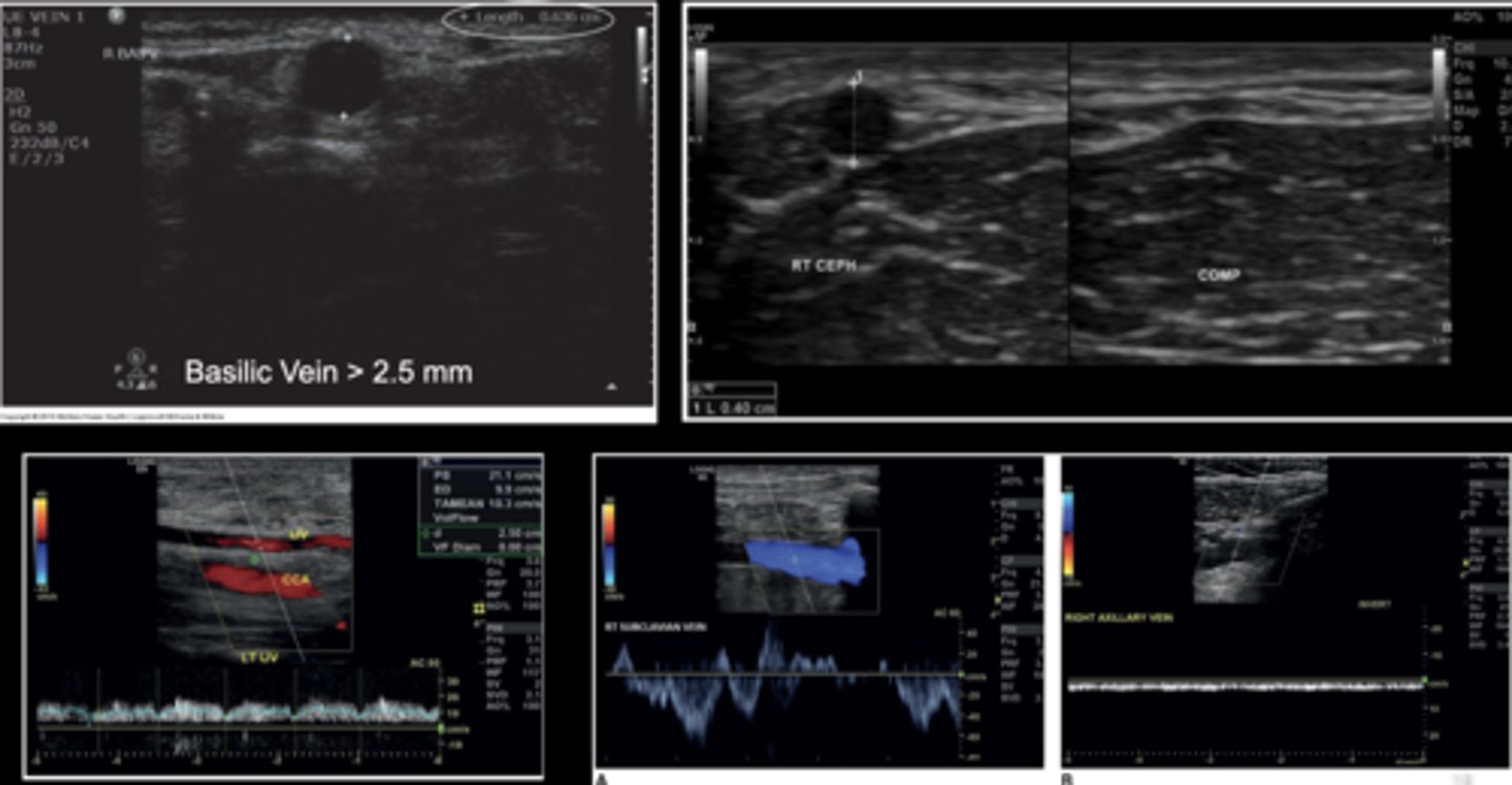 <p>Start with superficial system of non-dominant forearm</p><p>Begin with cephalic, basilic, and median cubical veins at wrist and move proximally to axilla</p><p>Assess for thrombus, compressibility, narrowing, tributaries , scarring- central veins have respirophasicity &amp; cardiac pulsatility</p><p>Compress &amp; record diameter every 2 cm</p><p>Doppler with augmentation (include subclavian &amp; IJV)</p><p>Measure vein diameter with &amp; without tourniquet (2 tourniquets-at axillary &amp; forearm-for 3 minutes)</p><p>Assess depth from skin surface to anterior wall of vein</p>