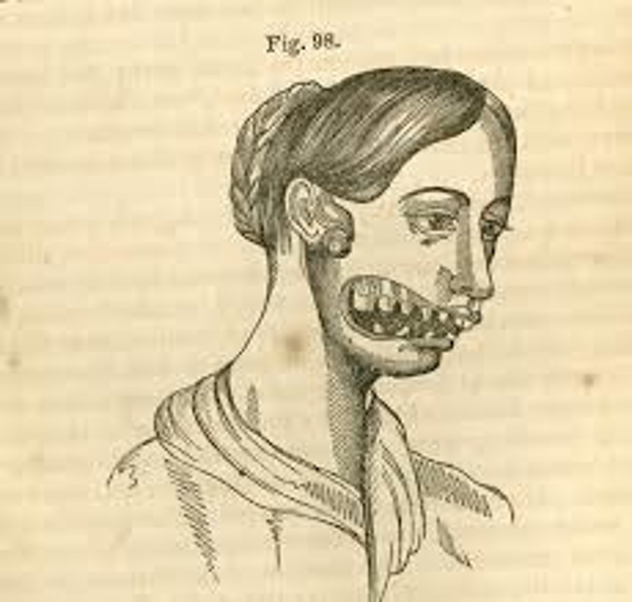 <p>A condition that girls working in the match factories got where the phospherous fumes rotted the flesh in the jaw</p>