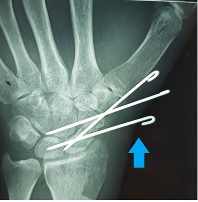 <ul><li><p>Fracture Stabilizers (For Hands &amp; Feet)</p></li></ul><p></p>