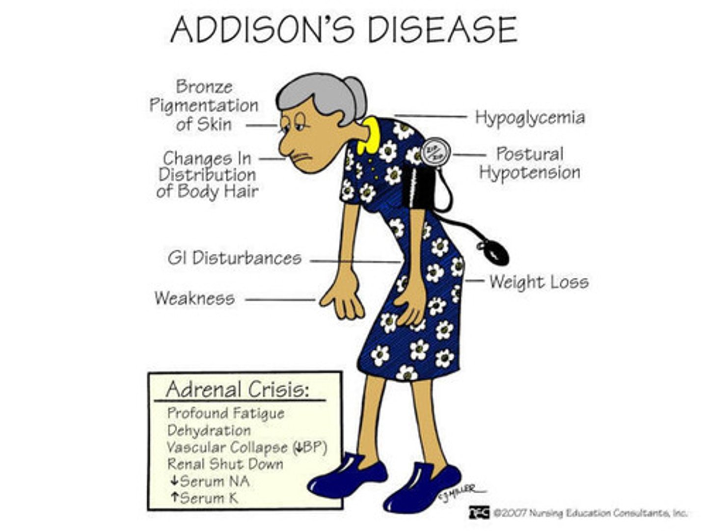 <p>Primary Adrenocortical insufficiency (e.g., Addison disease) causes increased ACTH and increased alpha-MSH production (skin pigment from POMC)</p><p>TB is most common cause in developing</p>