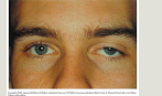 <p>ptosis</p>