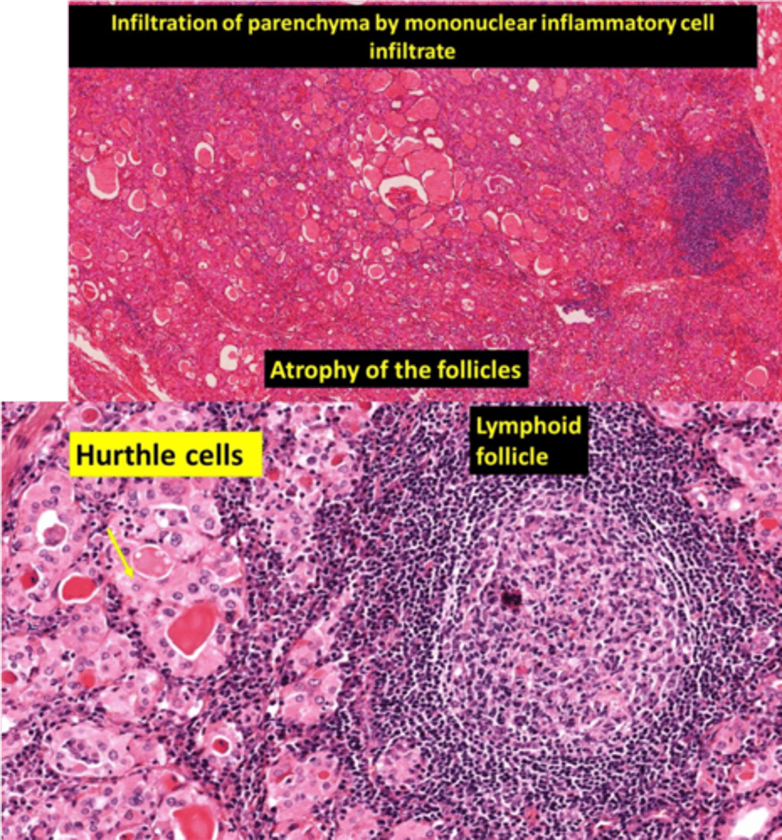 <p>Define Condition:</p><p>MCC of Hypothyroidism in Iodine Sufficient Regions</p><p>-Hx: A/w... (Autoimmune Diseases)</p><p>&gt; SLE</p><p>&gt; T1DM</p><p>-Path: Autoimmune response against Thyroid antigens (d/t breakdown of immune self-tolerance to thyroid autoantigens)</p><p>&gt; CD8+ T cells attack thyroid epithelial cells</p><p>&gt; Activation of CD4+ T cells --&gt; inflammatory cytokines (INF-gamma) release --&gt; Macrophage recruitment/activation --&gt; Follicle damage</p><p>&gt; Antithyroid Abs (Anti-TPO/Tg) = Cell mediated Cytotoxicity/Complement dependent damage</p><p>-Sx/PE:</p><p>&gt; NONTENDER thyroid enlargement (preceded by transient hyperthyroid state - aka Hashitoxicosis - d/t follicular reupture and TH release)</p><p>-Dx:</p><p>&gt; Labs =</p><p>&gt;&gt; (+) Anti-TPO (antimicrosomal Ab)</p><p>&gt;&gt; (+) Anti-Tg</p><p>&gt; Gross = Diffusely and symmetrically enlarged thyroid</p><p>&gt; Micro</p><p>&gt;&gt; Diffuse infiltration of thyroid parenchyma w/ lymphocytes and plasma cells</p><p>&gt;&gt; Lymphoid follicles w/ germinal centers</p><p>&gt;&gt; Atrophic thyroid follicles</p><p>&gt;&gt; Hurthle cell (abundant pink, granular cytoplasm) metaplasia d/t ongoing injury</p><p>-Prog: Risk of Non-Hodgkin B cell Lymphoma</p>