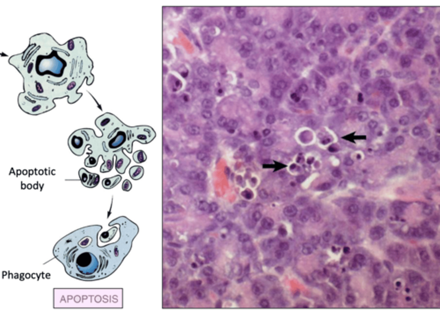 <p>cellular constriction- smaller cell with a dense cytoplasm and grouped granules</p><p>chromatin condensation- at the periphery in dense, crescent shaped masses</p><p>cytoplasmic vesicle and apoptotic body formation</p><p>apoptotic body phagocytosis</p>