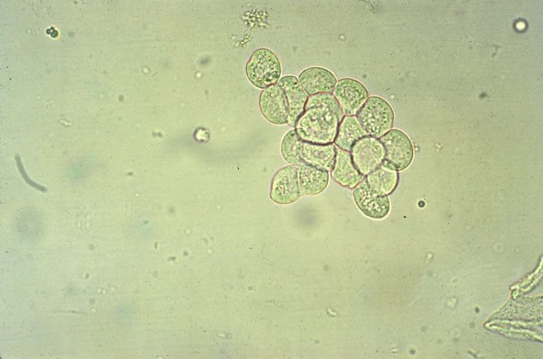 <p>Form as a result of stasis and necrosis of the tubules.</p><p>Presence can be seen in severe chronic kidney disease, exposure to nephrotic agents or viruses, rejection to kidney transplants. </p>