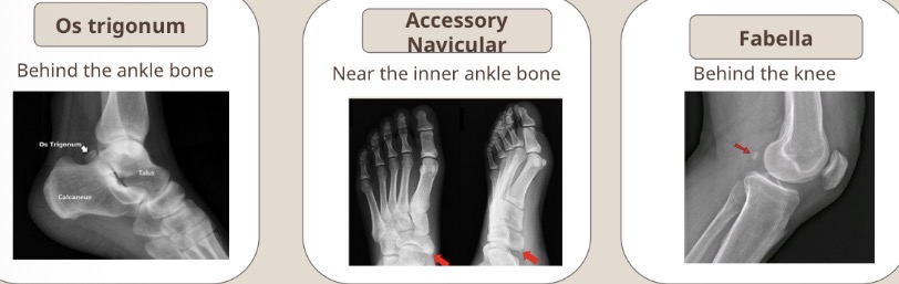 <p>Os trigonum</p><p>Accessory navicular </p><p>Fabella</p>