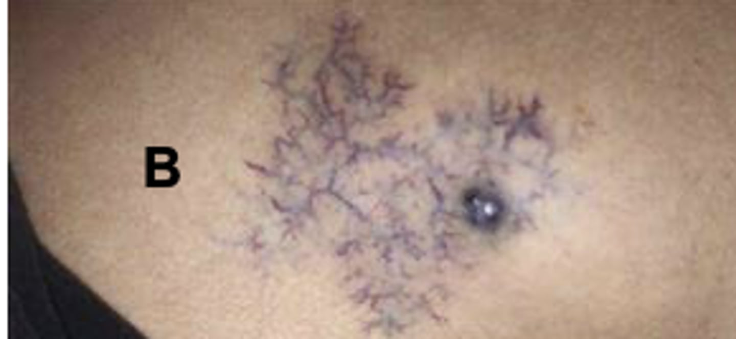 <p>VENOUS STAR</p>