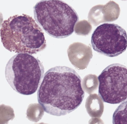 <p>which AML translocation is associated with the following information:</p><ul><li><p>5-8% of AML cases</p></li><li><p>myeloblasts, monoblasts, and promyelocytes in peripheral blood and BM</p></li><li><p>eosinophilia with dysplastic changes may be seen in BM</p></li><li><p>CNS involvement (relapse) </p></li><li><p>the genetic aberration is sufficient for diagnosis regardless of blast count</p></li></ul><p></p>
