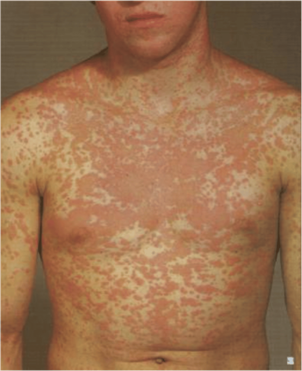 <p>diagnose this:</p><p>macular lesions 2-10 mm</p>