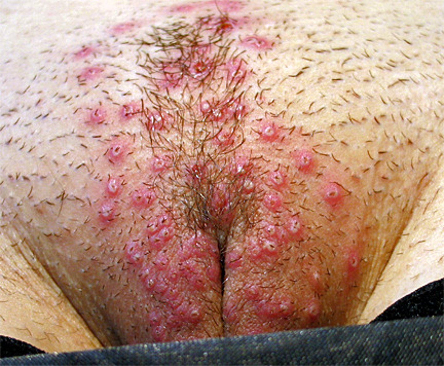 <p>sexually transmitted, ulcer-like lesions of the genital and anorectal skin and mucosa; after initial infection, the virus lies dormant in the nerve cell root and may recur at times of stress</p>