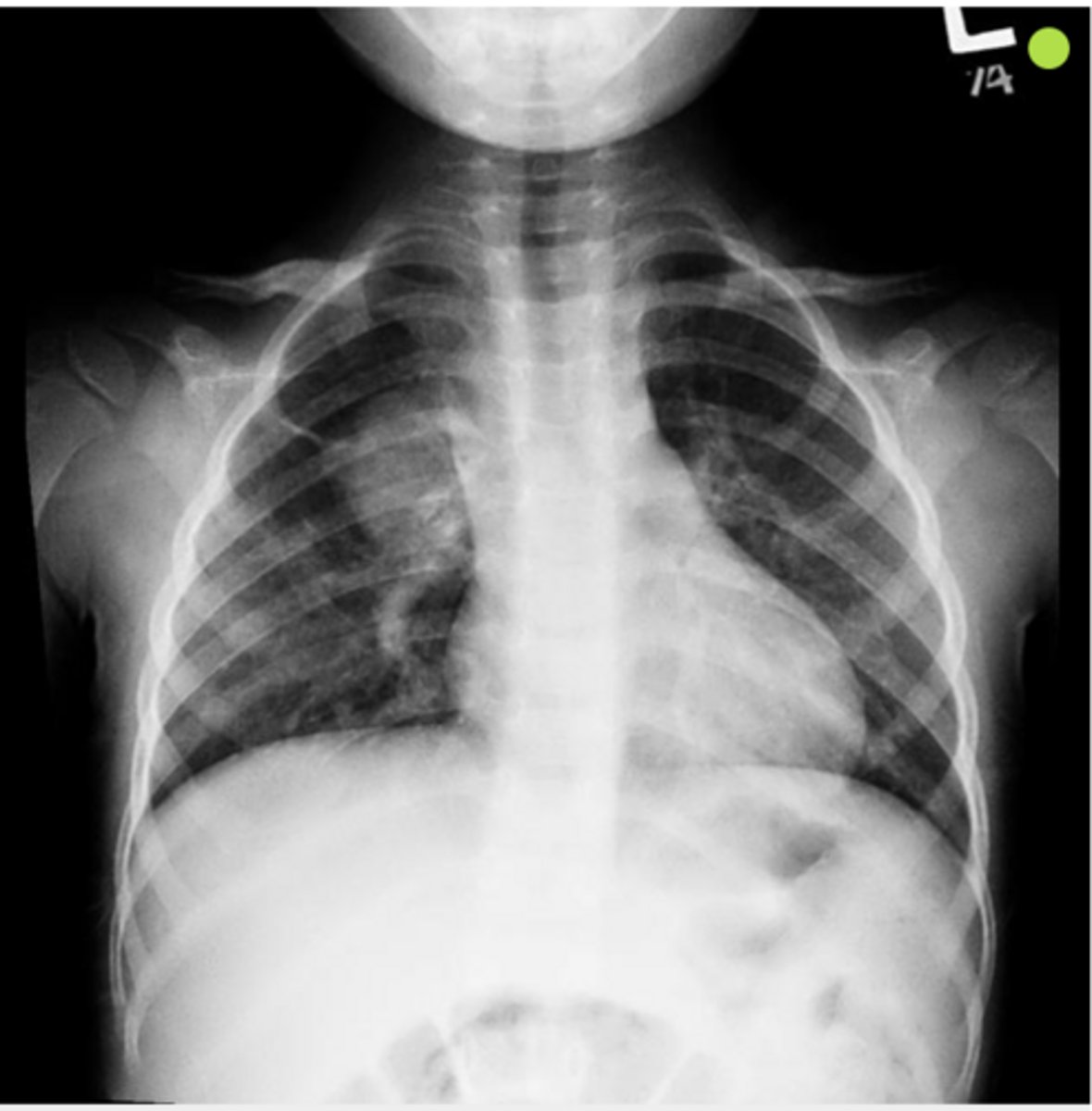 <p>A 7-year-old child presents with fever, sweats, and cough. Chest imaging shows a round, well-circumscribed pulmonary opacity. The infection remains localized due to underdeveloped pores of Kohn and canals of Lambert, limiting spread between lung subsegments.</p>