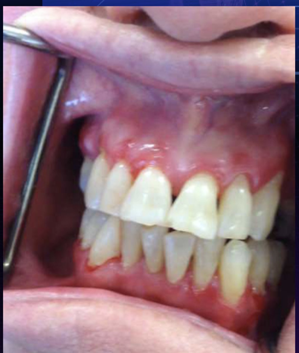 <p>This is the clinical manifestation of which condition?</p><p>- Female predilection</p><p>- Diffuse, markedly erythematous gingiva</p><p>- Generally involves attached tissues</p><p>- Sensitivity to spicy foods</p>