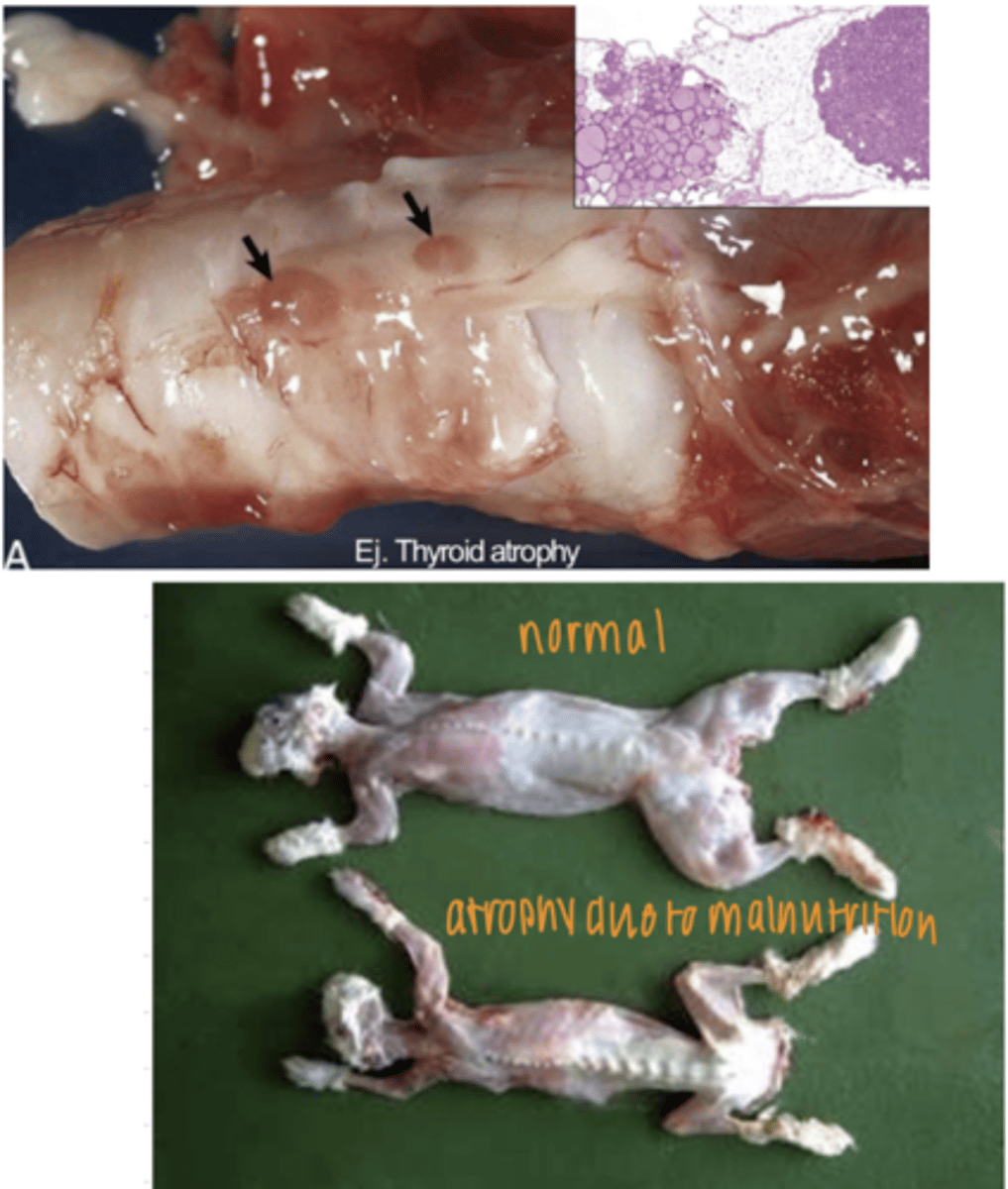 <p>decreased workload or disuse (ex- muscle fibers atrophy if the limb is not in use)</p><p>denervation (ex- muscle fibers atrophy rapidly is their motor neuron is injured)</p><p>deficient nutritive supply (ex- severe malnutrition causes the use of skeletal muscle for a source of energy after fat has been used)</p><p>loss of endocrine stimulation (ex- atrophy of thyroid gland if the pituitary gland supplies it with less thyrotropin)</p><p>decreased blood supply (ex- the liver atrophies if there is less blood flow through the portal vein)</p><p>selinity (age)</p><p>pressure- due to something occupying its space and compressing the tissue, causing a compromised blood supply (ex- a tumor, abscess, or cyst)</p><p>serous atrophy, due to malnutrition</p>