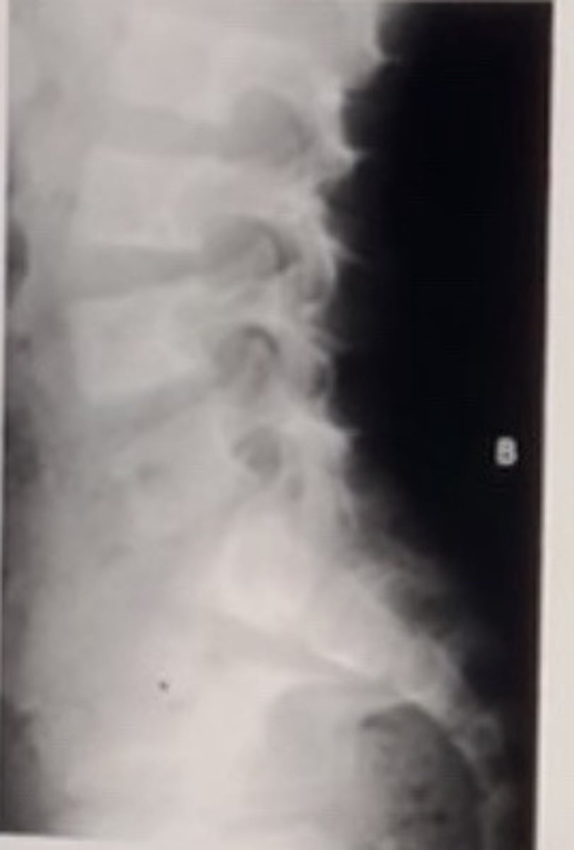 <p>The patient above demonstrates dilation of the thecal sac along with numerous nerve sheath tumors.</p><p>Most likely diagnosis:</p><p>Chordoma</p><p>Tubercular meningitis</p><p>Fibrous dysplasia</p><p>Neurofibromatosis</p>
