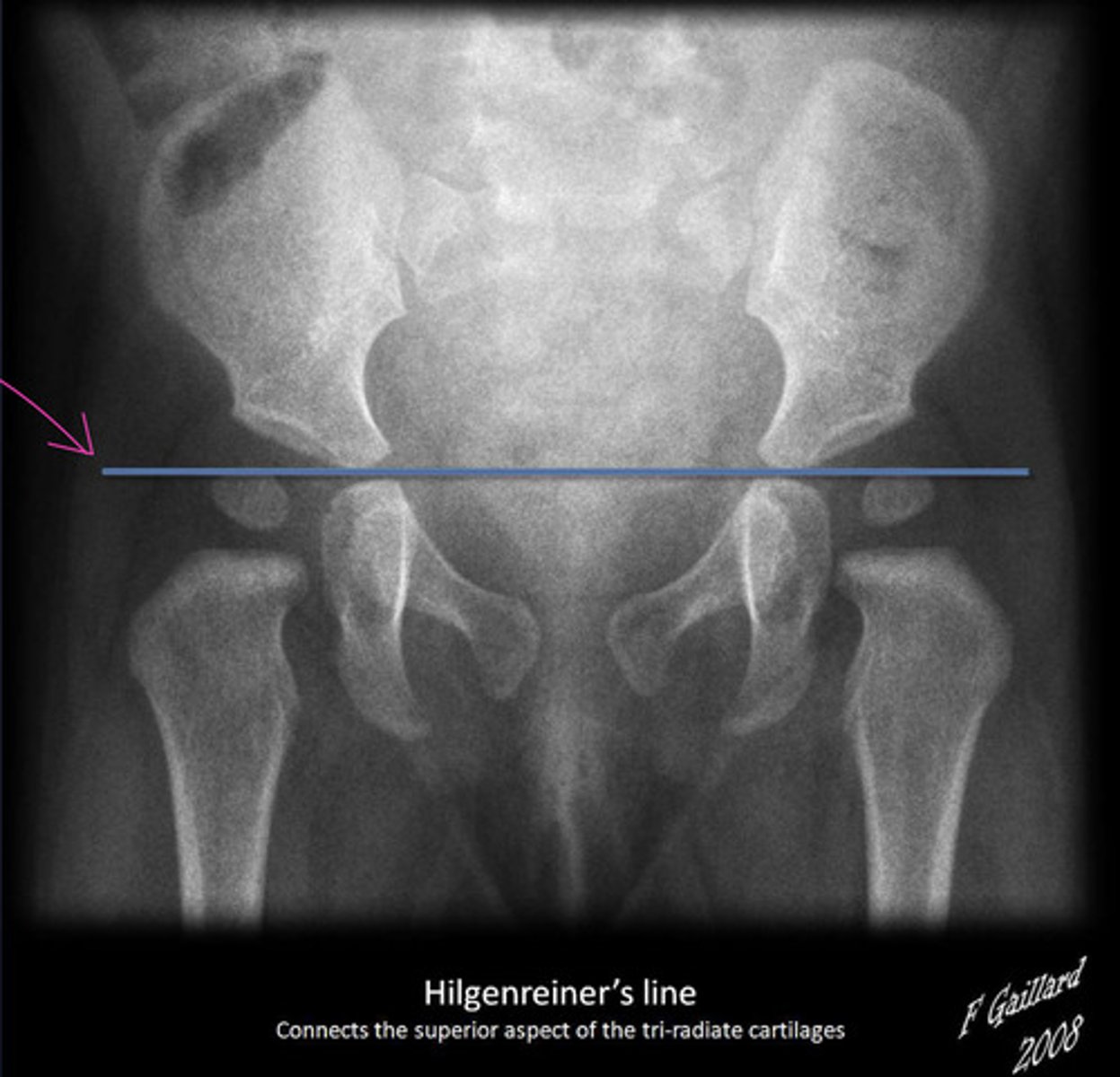 <p>Used for assessment of DDH</p><p>Line drawn horizontally, connecting the inferior aspect of the tri-radiate cartilages bilaterally >> femoral head should be below this line</p>