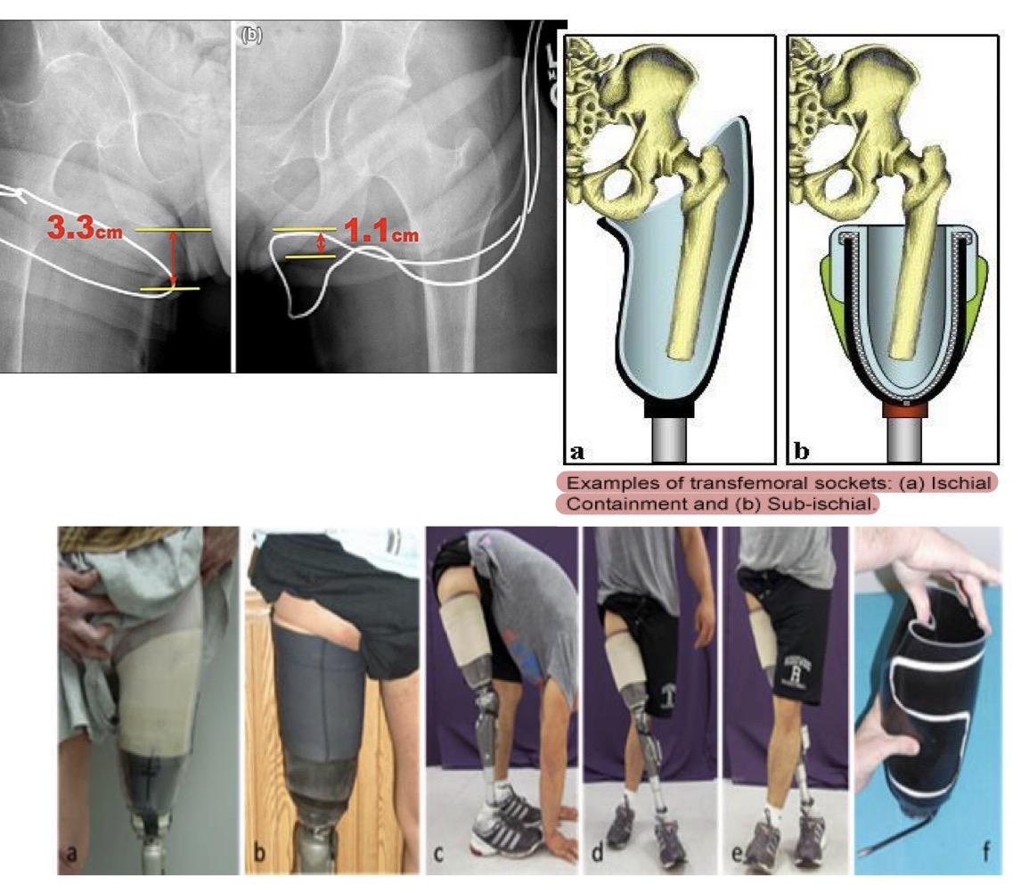 <p>-pt <strong>needs adequate hip strength</strong> for this since there is not bony block</p><p>-need long enough RL to be suspended</p><p>-if less than 50% of femur, this is not a good idea</p>