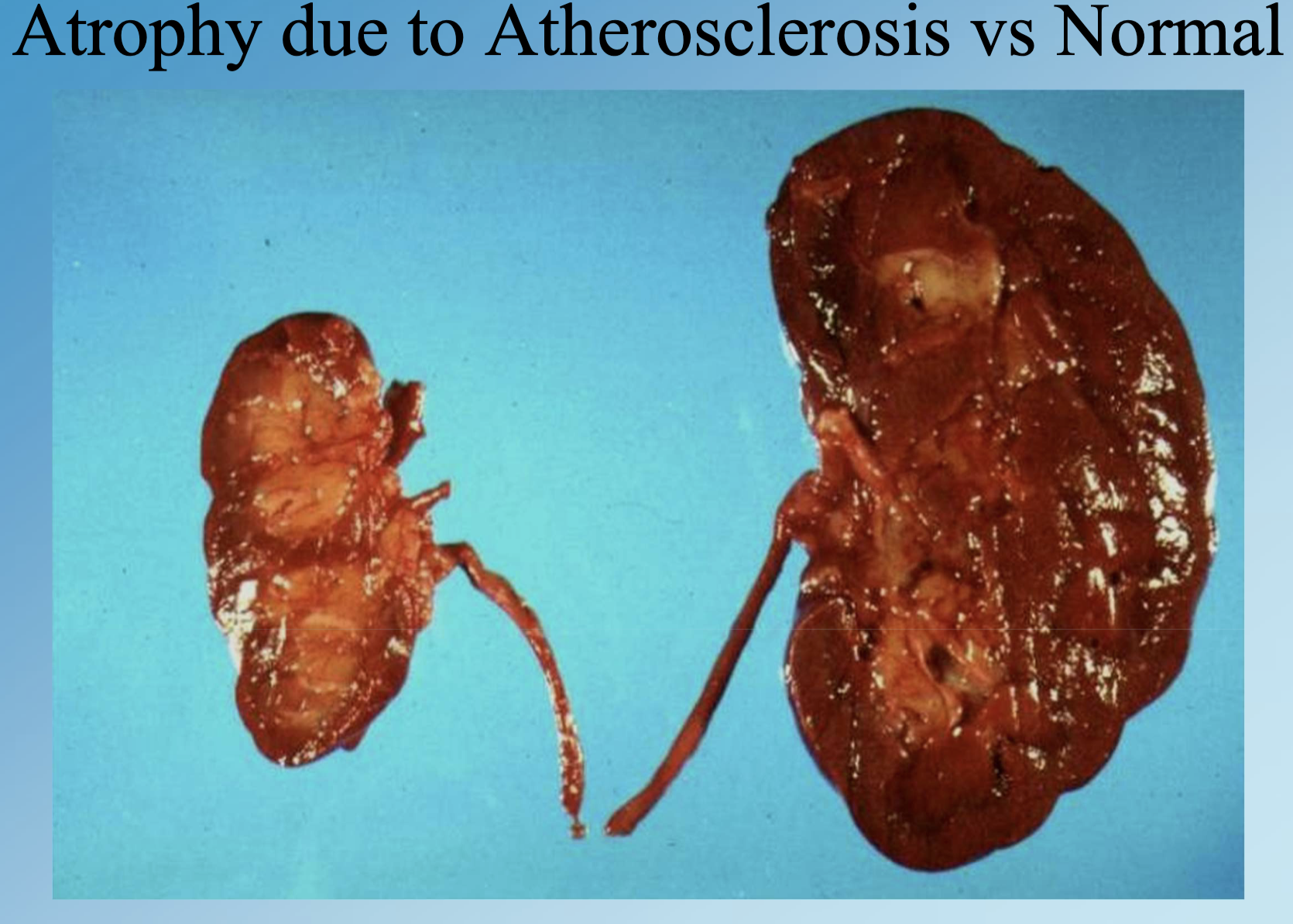 <p>Size reduction from disease or lack of use, e.g., ischemic kidneys, testicular atrophy, Alzheimer brain shrinkage.</p>