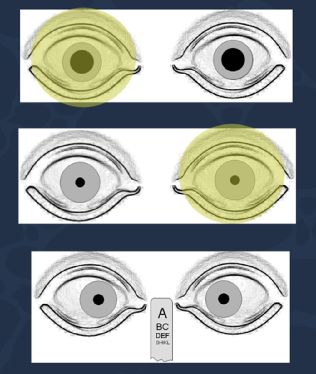 <p>amaurotic pupil reaction = total blindness in the eye that has no direct response...</p><p>no direct response in bad eye</p><p>no consensual response in good eye</p><p>direct response in good eye</p><p>consensual response in bad eye</p><p>near response intact OU</p>