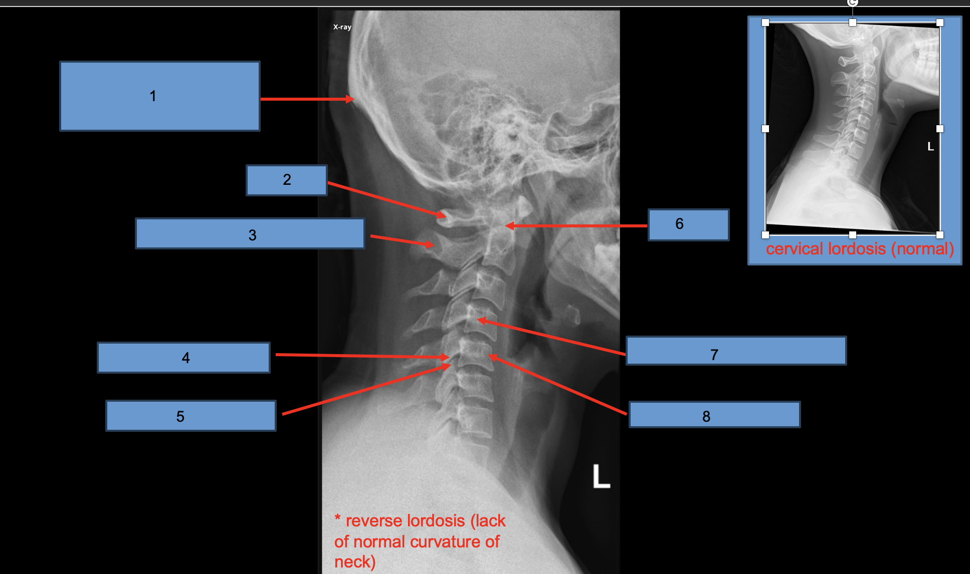<p>8; what vertebrae are displayed?</p>