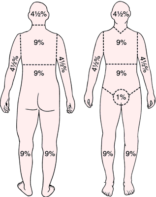 <p>Total Body Surface Area:<strong> used to calculate exact amount of fluid resuscitation needed</strong></p><p><span style="font-family: &quot;Times New Roman&quot;, serif"><strong><u>Head and neck</u></strong>: 9% total (4.5% front and back)</span></p><p><span style="font-family: &quot;Times New Roman&quot;, serif"><strong><u>Arms:</u></strong> 9% total each arm (4.5% front and back)</span></p><p><span style="font-family: &quot;Times New Roman&quot;, serif"><strong><u>Legs:</u></strong> 18% total each leg (9% front and back)</span></p><p><span style="font-family: &quot;Times New Roman&quot;, serif"><strong><u>Upper and lower back:</u></strong> 9% each → together 18%</span></p><p><span style="font-family: &quot;Times New Roman&quot;, serif"><strong><u>Perineum</u></strong>: 1%</span></p>