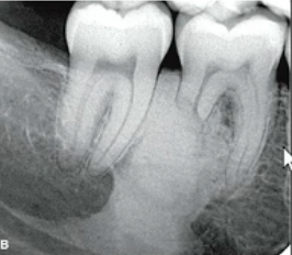 <p>periapical <strong>radiopacity</strong> of VITAL tooth </p>