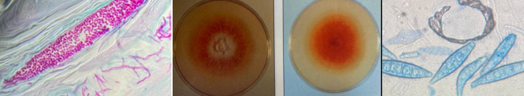 <p><span style="font-family: &quot;Times New Roman&quot;, serif; line-height: 107%;"><span>Clinical associations: ringworm (dogs, cats = M. canis; cattle = T. verrucosum)</span></span></p><p class="MsoListParagraphCxSpMiddle"><span style="font-family: &quot;Times New Roman&quot;, serif; line-height: 107%;"><span>Histology (PAS): arthroconidia on/outside hair (ectothrix)(bring pink/red staining arthrospores called arthroconidia outside hair shaft)</span></span></p><p class="MsoListParagraphCxSpMiddle"><span style="font-family: &quot;Times New Roman&quot;, serif; line-height: 107%;"><span>KOH prep: clear keratin </span></span><span style="line-height: 107%;"><span>à</span></span><span style="font-family: &quot;Times New Roman&quot;, serif; line-height: 107%;"><span> reveals fungal arthrospores</span></span></p><p class="MsoListParagraphCxSpMiddle"><span style="font-family: &quot;Times New Roman&quot;, serif; line-height: 107%;"><span>Culture (SAB-CC): selective fro dermatophytes</span></span></p><p class="MsoListParagraphCxSpLast"><span style="font-family: &quot;Times New Roman&quot;, serif; line-height: 107%;"><span>Microscopy: M. canis = spindle macroconidia with terminal knob</span></span></p><p class="MsoListParagraphCxSpLast"><span style="font-family: &quot;Times New Roman&quot;, serif; line-height: 107%;"><span>What is it?</span></span></p>