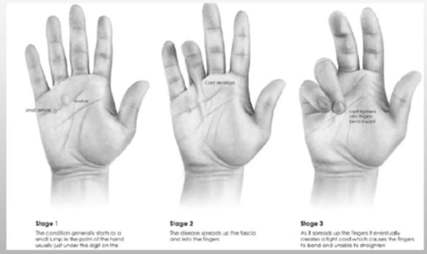 <p>Dupuytren's contracture</p><p>- affects the 4th and 5th digits</p>