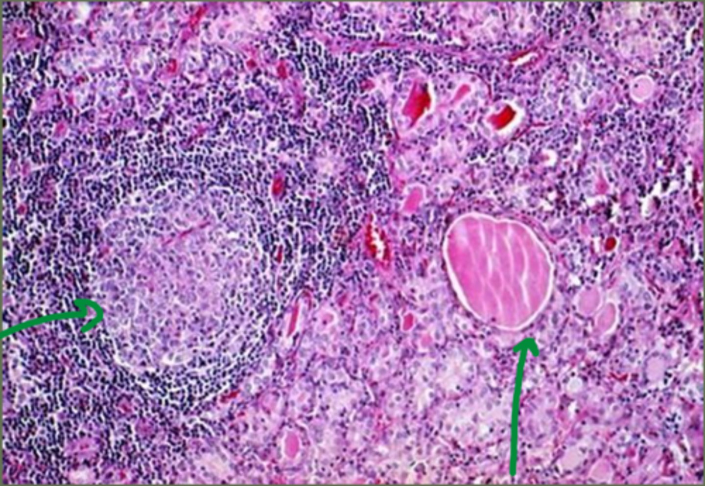 <p>Which of these follicles from a thyroid gland is typical of hashitmotos disease?</p>
