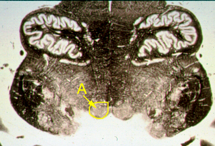 <p>Identify the structure indicated by the outline and letter "A".</p><p><span>A. Dorsal motor nucleus of the vagus</span></p><p><span>B. Solitary nucleus and tract</span></p><p><span>C. Hypoglossal nucleus</span></p><p><span>D. 4th ventricle</span></p><p><span>E. Pyramid</span></p><p></p>