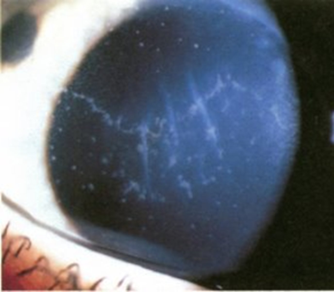 <p>What sign of graft rejection, a complication of PKP, is seen here?</p>