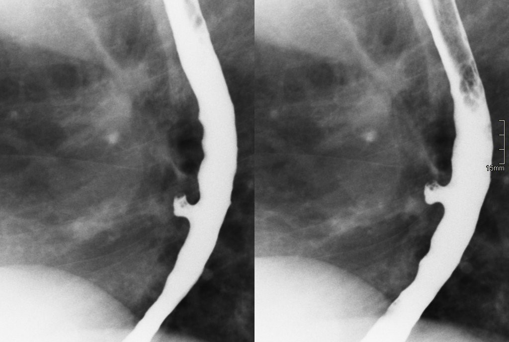 <p>Outpouchings, are common lesions that herniate through the muscular layer of the esophagus</p>
