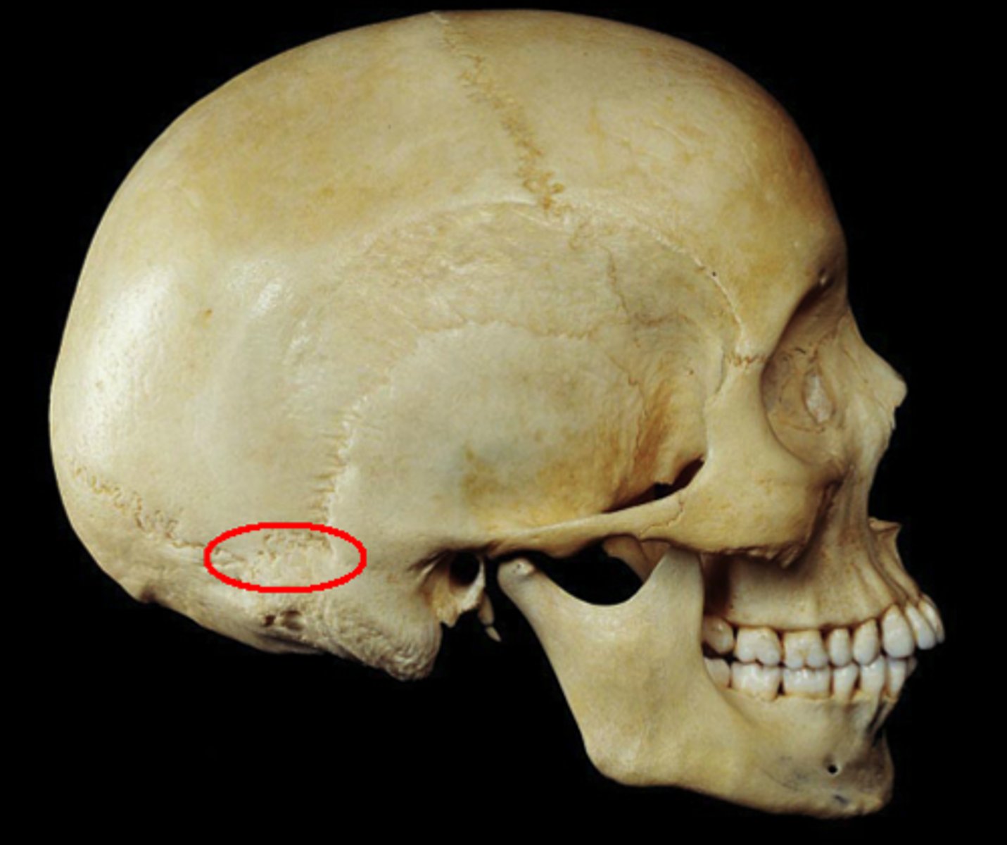 <p>located at asterion (where lamb-doidal suture contacts the temporal; parietomastoid suture)</p>