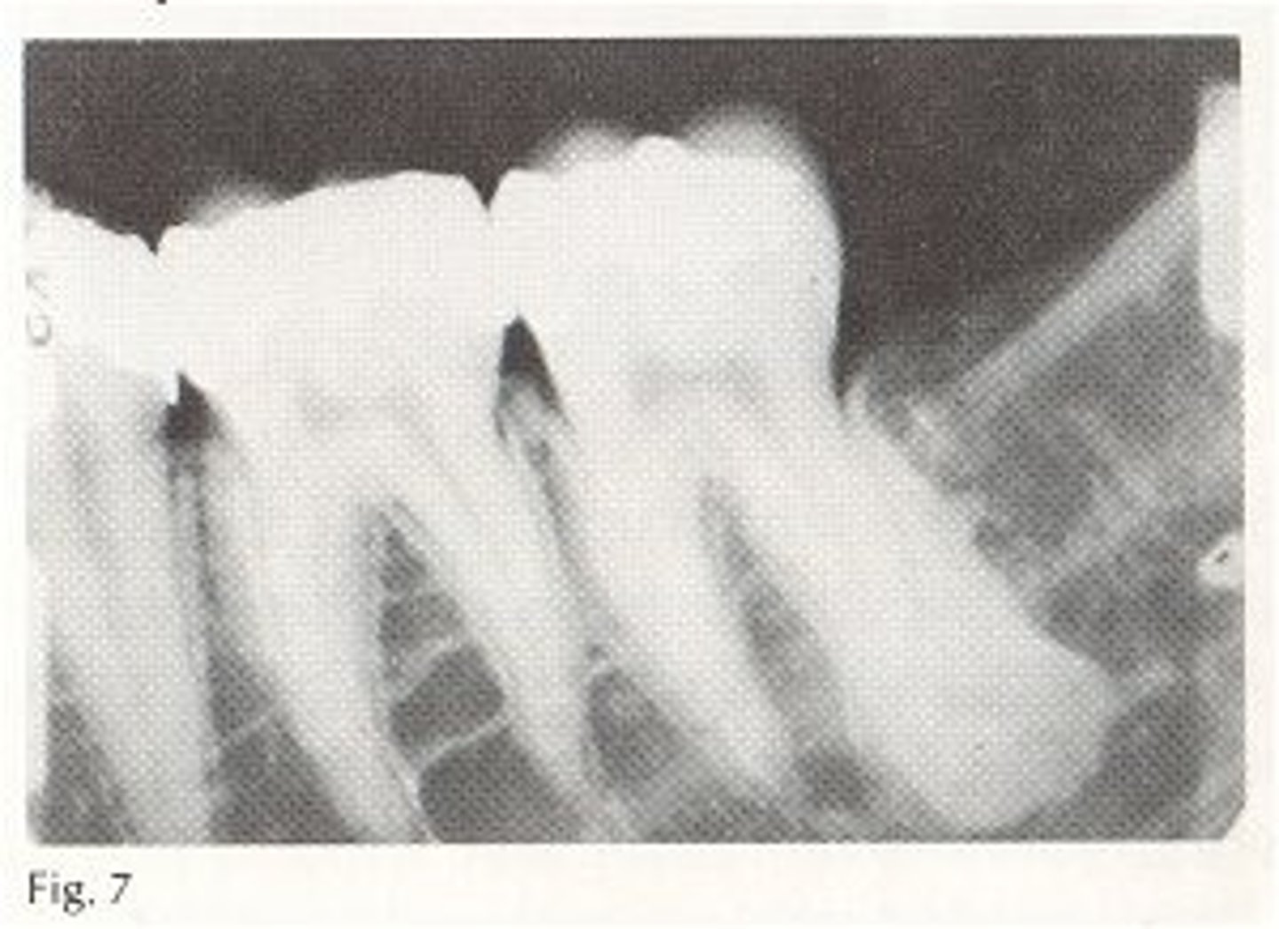 <p>common locations: posterior mandible 90%</p><p>radiographic: it is a focal area of radiopacity which often affects PA/interradicular bone; involves vital teeth</p><p>population: arises in children 10-20yrs</p>