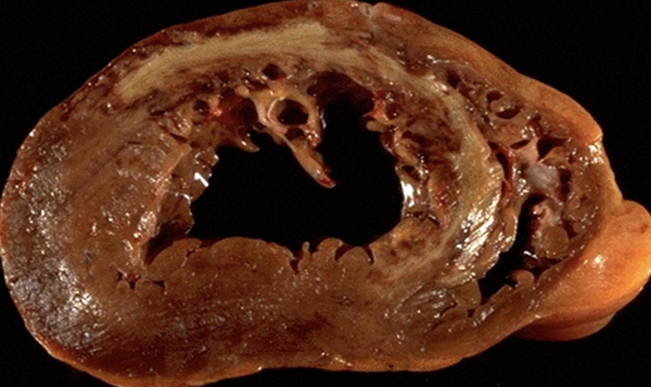 <p>Acute necrosis of heart muscle due to coronary artery thrombosis, e.g., LAD occlusion.</p>