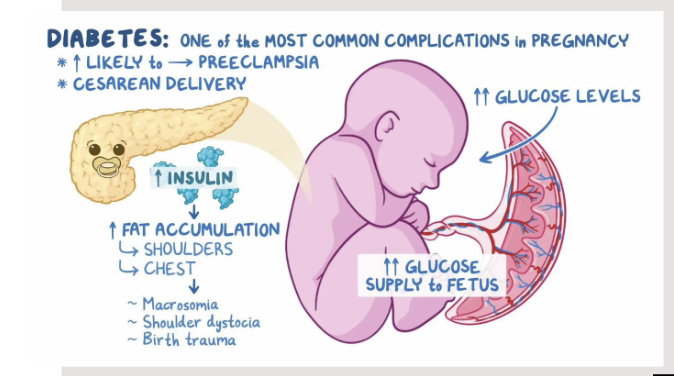 <ul><li><p>glucose intolerance that develops during pregnancy</p></li><li><p>increased risk of&nbsp;</p><ul><li><p>miscarriage</p></li><li><p>macrosomia / LGA infant</p></li><li><p>neural tube defect</p></li><li><p>disproportionate chest / shoulder size</p></li><li><p>polydramnios</p></li><li><p>preeclampsia</p></li><li><p>ketoacidosis (DKA)</p></li><li><p>infection</p></li></ul></li></ul><p></p>
