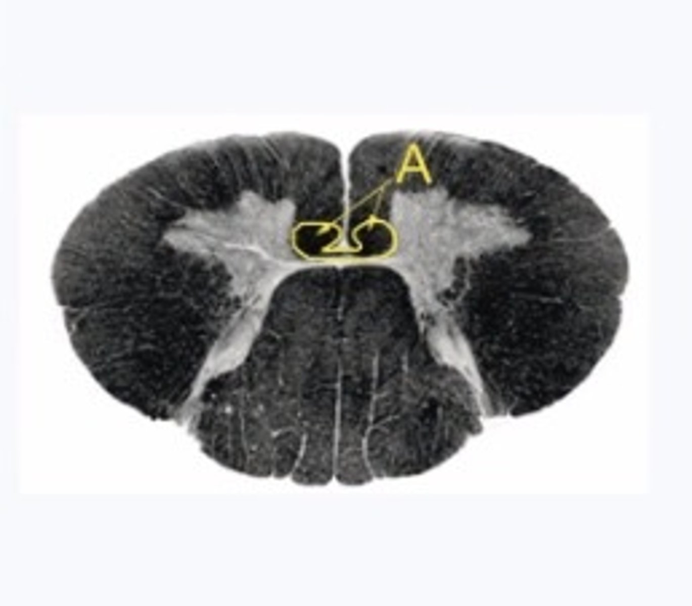 <p>Describe the signs/symptoms that you will see if structure "A" is lesioned.</p>