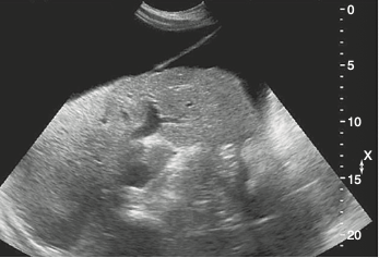 <p><span>Which of the following ligaments is demonstrated in this sagittal image of the liver?<br></span></p>